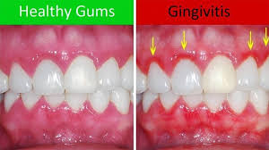 gingivitis periodontal disease