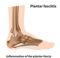 night splints for plantar fasciitis