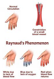 swimming with raynaud s syndrome