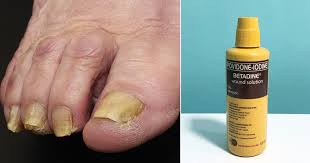 does betadine kill toenail fungus
