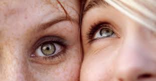 veins under eyes causes treatment
