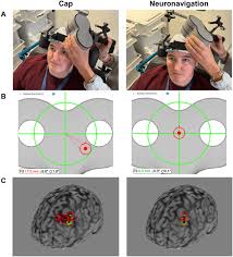 neuronavigation maximizes accuracy and