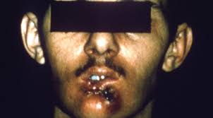 It describes abnormal cells in the lining of the lips or oral stage i describes a very early stage of cancer. Mouth Cancer Symptoms Diagnosis And Treatment