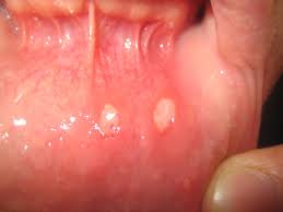 Eine mundschleimhautentzündung durch herpesviren bezeichnet man als mundfäule. Aphthe Wikipedia