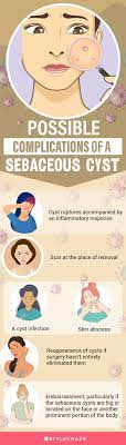 14 home remes to treat sebaceous cysts