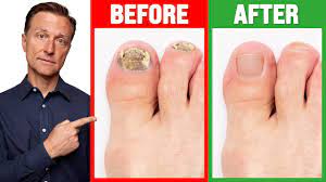 the real cause of toenail fungus is