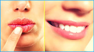 home remes for dry and chapped lips