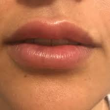dark spots in my lips after filler 1