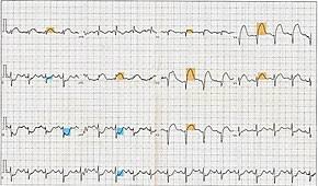 Electrocardiography In Myocardial Infarction Wikipedia