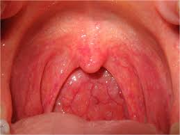 Doctors know that throat cancer is caused by a genetic mutation in the cells of the throat, though they are not sure what spurs this mutation. Bumps In Back Of Throat Causes Pictures And Treatment