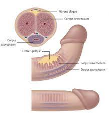 Penile Curvature — Urology Care Toowoomba | Dr Nikhil Sapre Urologist