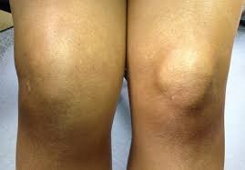 swollen knee treatment how to reduce