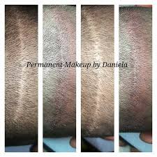 scalp pigmentation saint petersburg