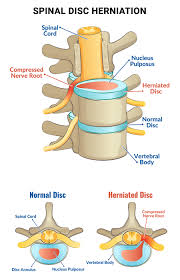 can herniated disc cause constipation