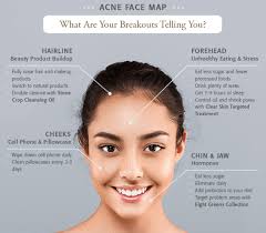 acne face map what are your breakouts