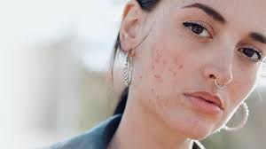 breakouts tell you about your acne