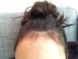 Baby hair arises when the hair does not grow further in the anagen phase. Reality Of Being A Yummy Mummy Baby Hairs After Pregnancy