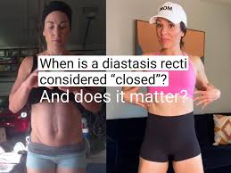 when is diastasis recti considered
