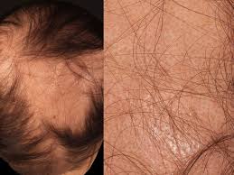 If he sees improvement, he will continue with prn. Alopecia Areata Overview Altmeyers Encyclopedia Department Dermatology