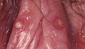 They can be small or large, itchy or hard spots that don't itch. Clinical Presentations Of How Hsv 1 Hsv 2 Can Present