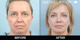 The smas facelift / neck lift / cervicofacial lift hospitalization for 24 to 48 hours is required for this type of intervention. Toronto Mini Facelift Clinic Toronto Spamedica