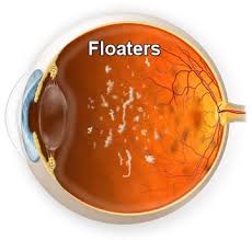 The accumulation of fluid may separate the retina from the underlying tissue, which results in retinal detachment. What Are Floaters Treatment Of Floaters