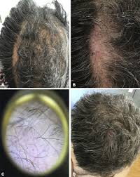a and b hair loss after 13 months of