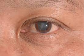 cloudy vision after cataract surgery
