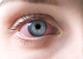 5 rare eye conditions that