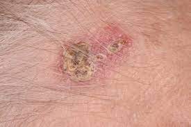 symptoms of non melanoma skin cancer nhs