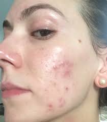 quelles sont les causes de l acné