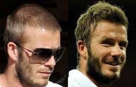 Explore our website to learn about hair transplant cost in dubai, surgeons, tools, and techniques. Celebrities With Hair Transplants Skalptec Uk And Europe