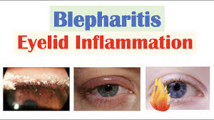 blepharitis eyelid inflammation