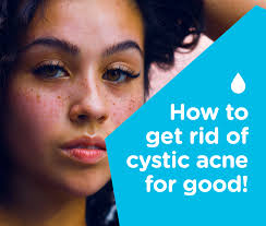 the truth about cystic acne and how you