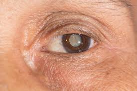 can you exercise after cataract surgery