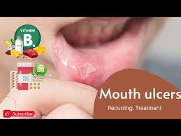 mouth ulcer why they come frequently