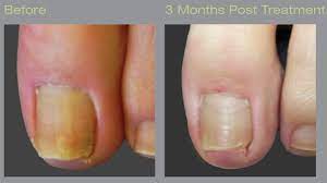 laser treatment for nail fungus what