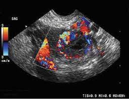 ectopic pregnancy color doppler