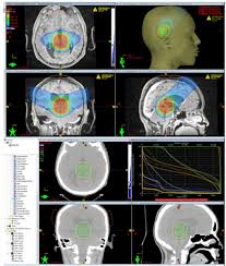 proton therapy for central nervous
