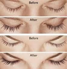 Anything that disrupts other hair growth can disrupt eyelash growth also, from malnutrition to chemotherapy to severe physical or emotional stress. Latisse Eyelash Enhancement Toms River Nj