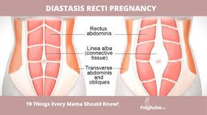 diastasis recti pregnancy symptoms