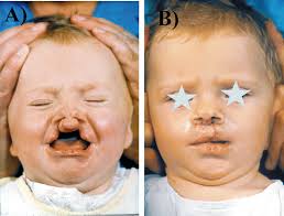 cleft lip and palate repair