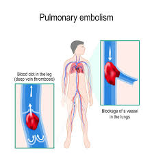 When should someone seek medical care. What Is A Pulmonary Embolism Health Beat