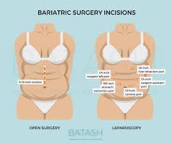 bariatric surgery scars where and what