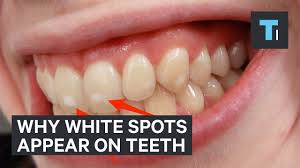 white spots on their teeth