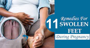 remes for swollen feet during pregnancy