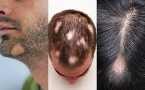circular or patchy hair loss