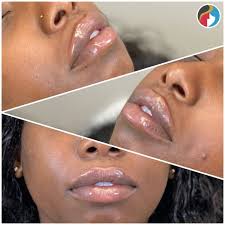 rejuvn8 lip filler treatment in