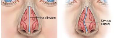 septoplasty conditions treatments sgh
