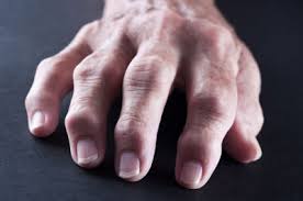 Image result for rheumatoid arthritis